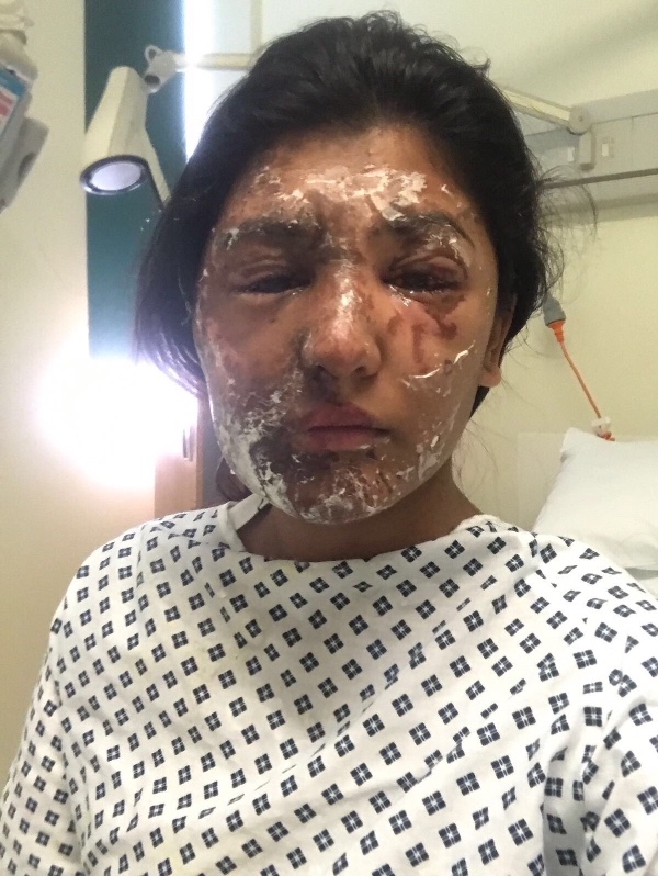 Resham Khan Acid Attack Victim
