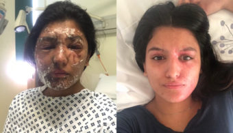 Acid Attack Victim Resham Khan Before and After