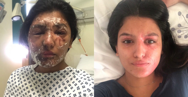 Acid Attack Victim Resham Khan Before and After